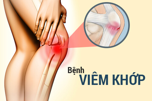do bị viêm khớp gối